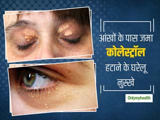 आंखों के साइड में जमे कोलेस्ट्रॉल (पीली पपड़ी जैसी त्वचा) को हटाने के लिए 5 घरेलू उपाय
