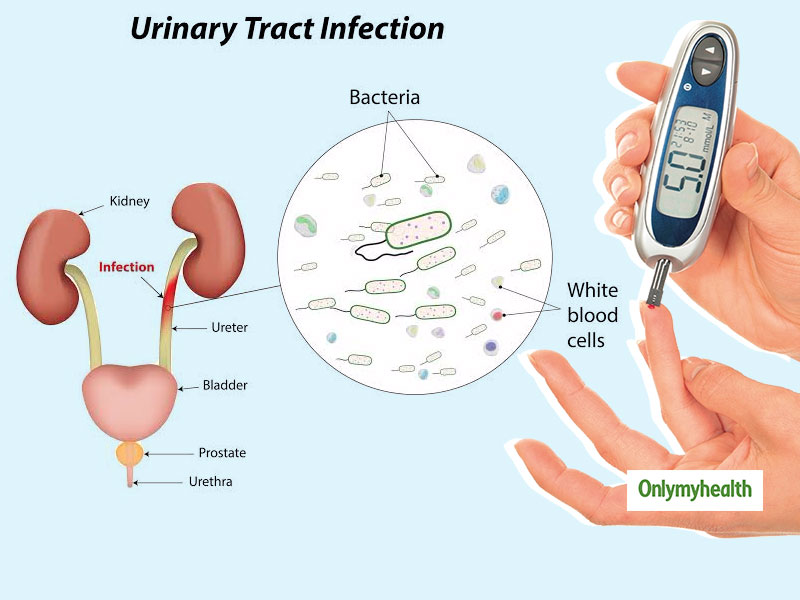 Urinary Tract Infection And Diabetes: Join The Missing Dots With Dr Sanjeev Gulati