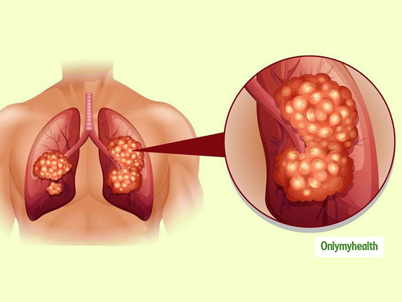 Lung Cancer: प्रदूषण बन रहा है फेफड़ों के कैंसर की वजह- डॉक्‍टर रवि गौड़