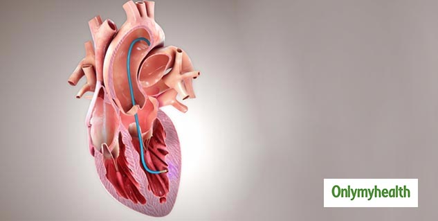 Stent And Bypass Surgery 