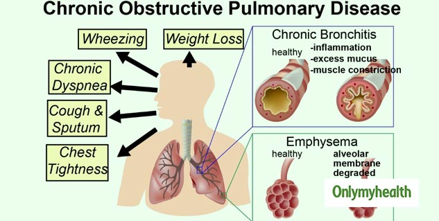 World COPD Day 2019: An Air Purifier Can Be A Collective Solution To ...