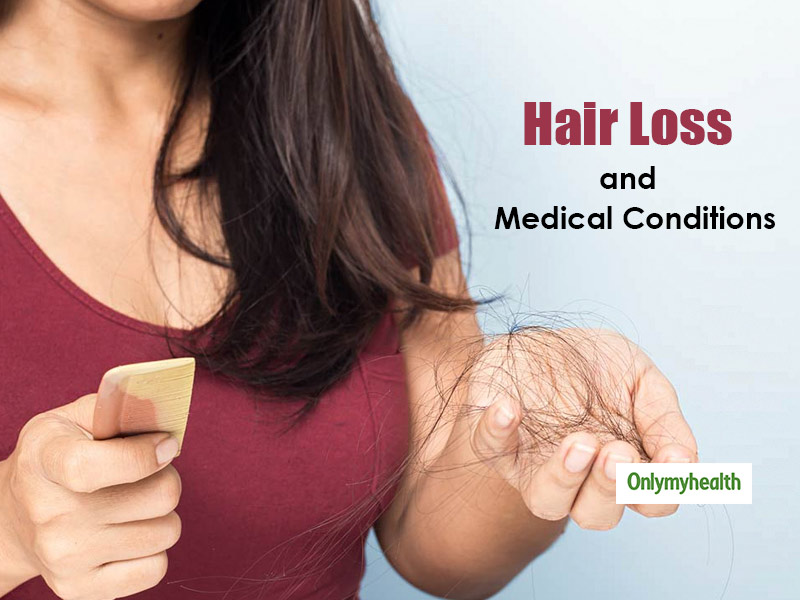 Hair Loss Is Alopecia Areata the Cause  By Dr VSethu Raman  Lybrate