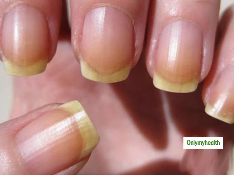 What Causes Of Yellow Nails In Hindi । इन कारणों से होते हैं आपके नाखून  पीले, देखें कैसे दूर करे नाखून का पीलापन