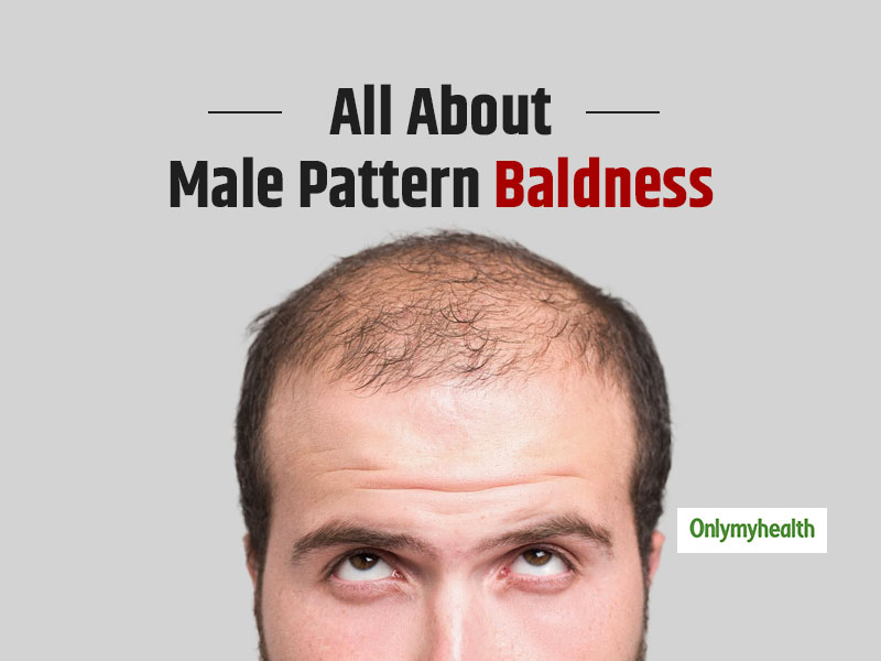 early male pattern baldness