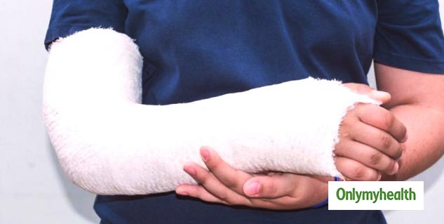 5 Diet Rules To Follow To Make Your Bone Fracture Heal Faster