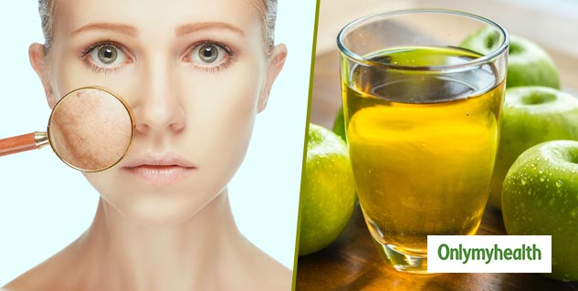 Apple Cider Vinegar For Skin
