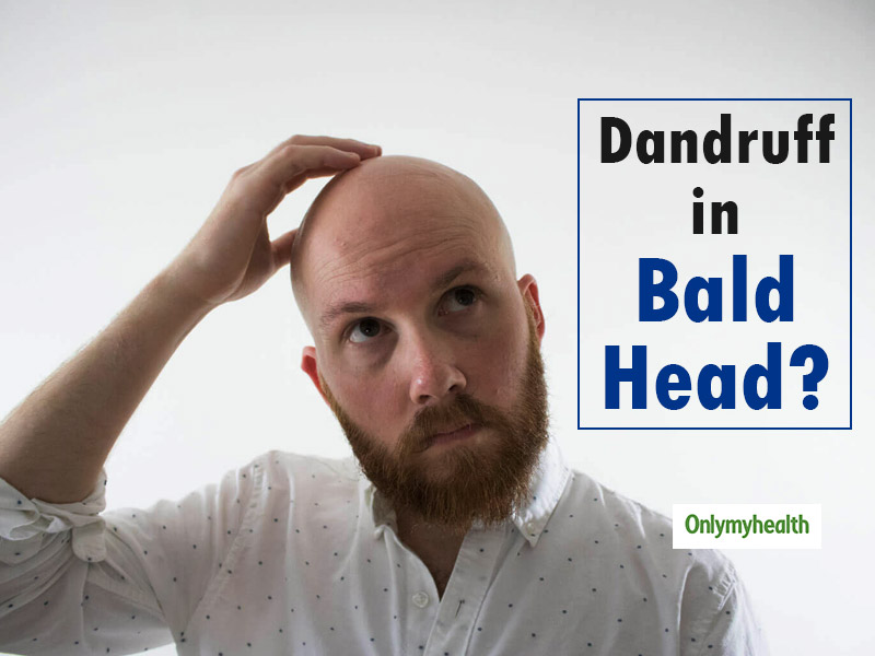 Can Bald People Get Dandruff?