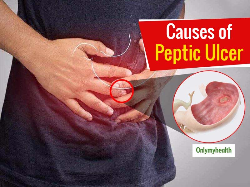 Peptic ulcers often develop due to bacteria infection