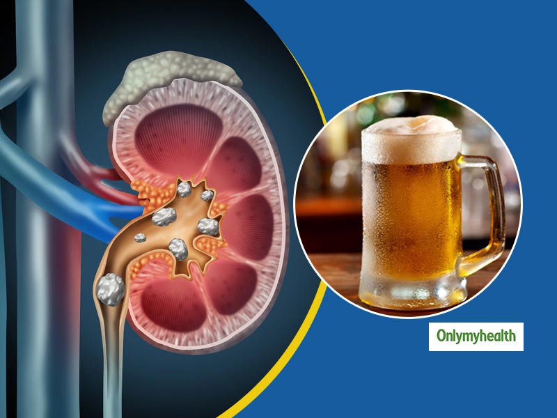 can-drinking-beer-help-get-rid-of-kidney-stones-onlymyhealth