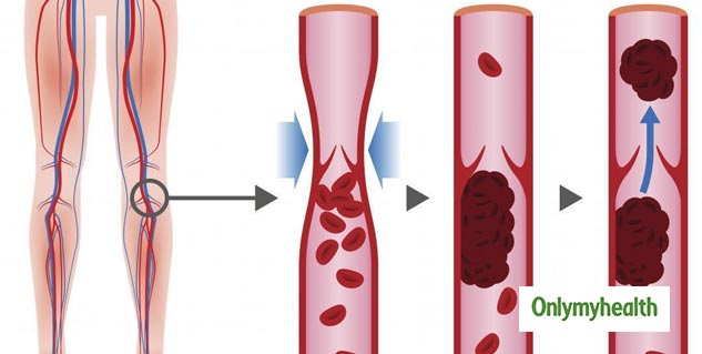 The Truth About Sex Differences In Deep Vein Thrombosis