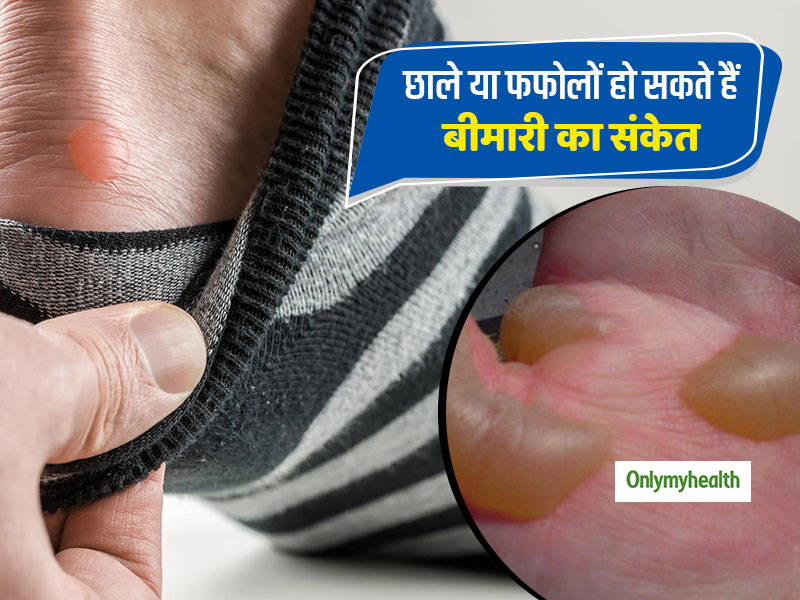 Blister meaning best sale in hindi