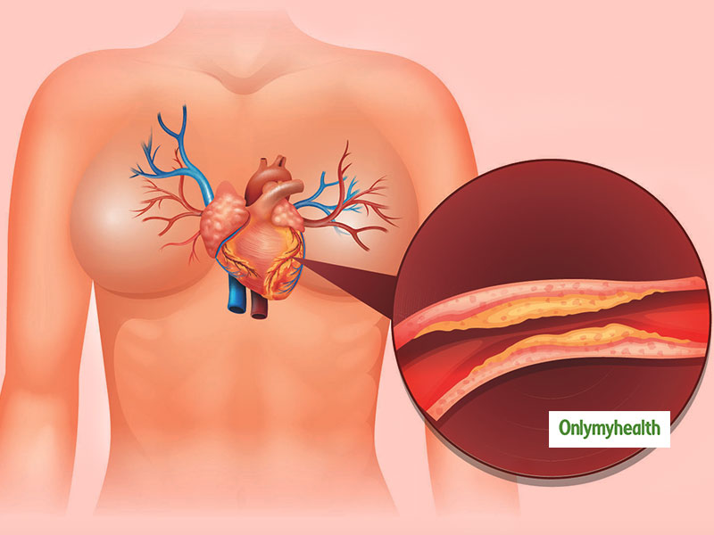 Heart Bypass Surgery: हार्ट बाईपास सर्जरी क्‍या है, कैसे की जाती है, जानें इसके खतरे और रिकवरी टाइम