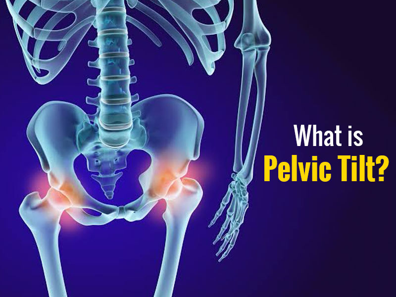 Anterior pelvic tilt: Fixes, causes, and symptoms