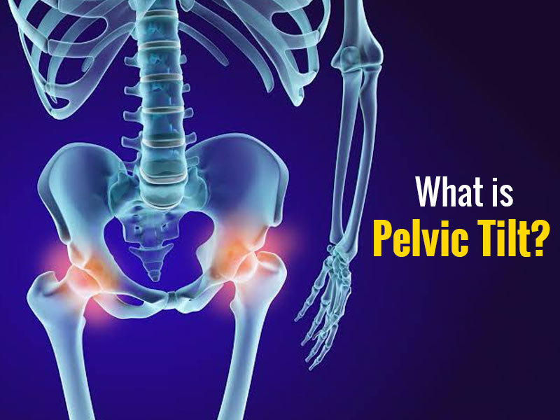 what-is-anterior-pelvic-tilt-and-how-can-you-fix-it-onlymyhealth