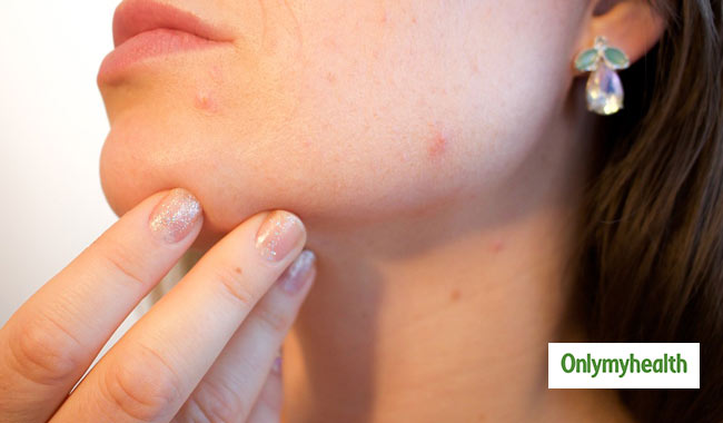 Chin Acne Giving You Sleepless Nights? Get Rid Of Acne With These
