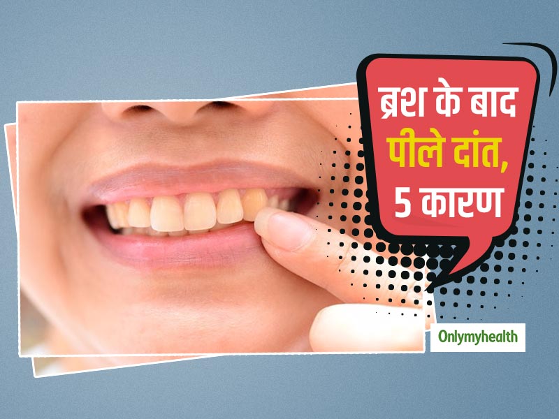 रोजाना ब्रश करने के बाद भी क्‍यों पीले रहते हैं आपके दांत, जानें ये 5 कारण