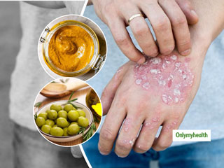 Home Remedies: सर्दियों के मौसम में बढ़ जाता है सोरायसिस का खतरा, इन 5 उपायों से करें बचाव 