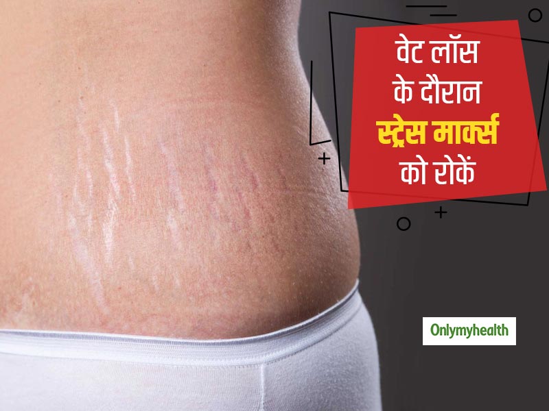 वजन घटाने के दौरान स्ट्रेच मार्क्स और थुलथुली त्वचा से बचना है तो अपनाएं ये 5 टिप्स