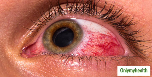 Avoid Glaucoma