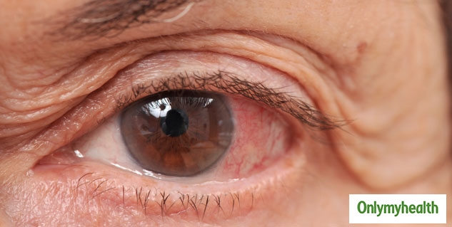 Avoid Glaucoma