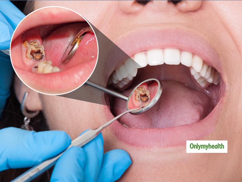 Tooth Decay: सिर्फ मीठे से ही नहीं इन 5 कारणों से भी होती है दांतों में सड़न, जानें बचाव के टिप्‍स