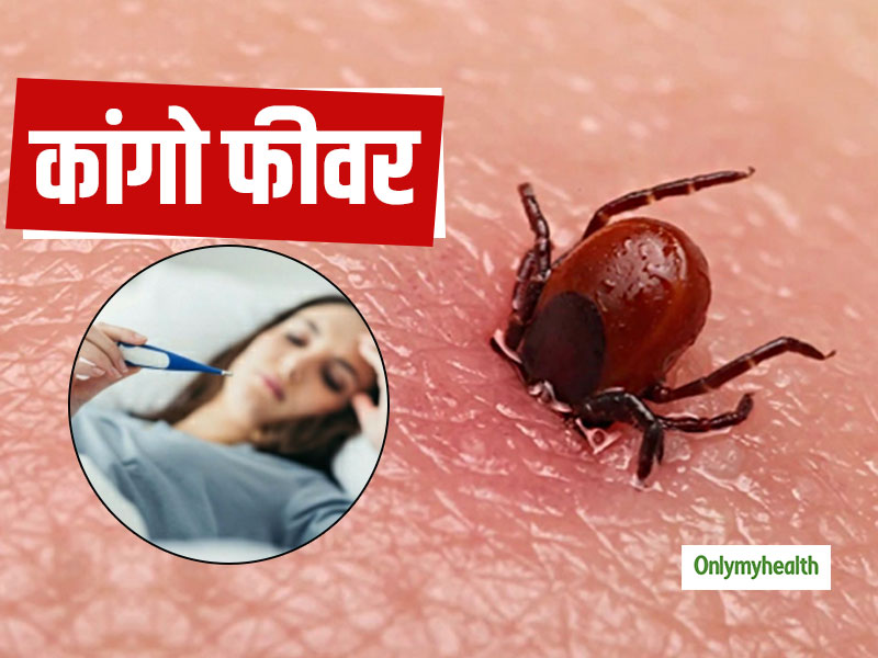 जानलेवा कांगो फीवर से गुजरात में 3 की मौत, जानें क्‍या है कांगो बुखार के लक्षण व बचाव के उपाय 