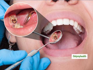 Tooth Decay: सिर्फ मीठे से ही नहीं इन 5 कारणों से भी होती है दांतों में सड़न, जानें बचाव के टिप्‍स