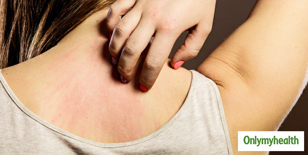 Everything You Need To Know About Keto Rash