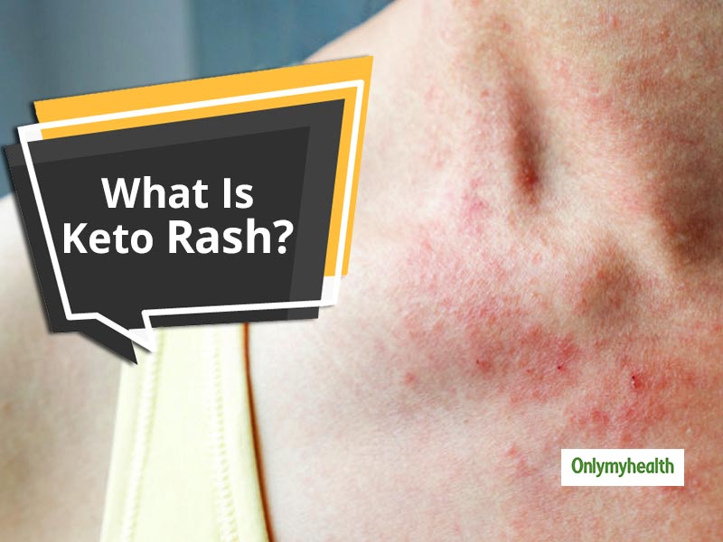 Everything You Need To Know About Keto Rash | OnlyMyHealth