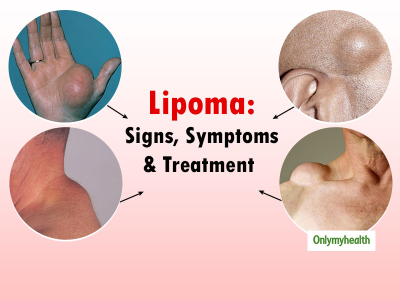 Lipoma symptoms
