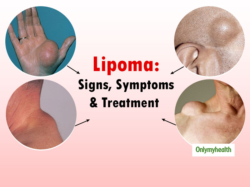 Lipoma Ultrasound Treatment