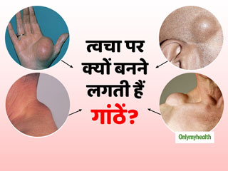 त्‍वचा पर ऊभरी हुई गांठें लिपोमा का है संकेत, जानें क्‍या हैं इसके खतरे और उपचार