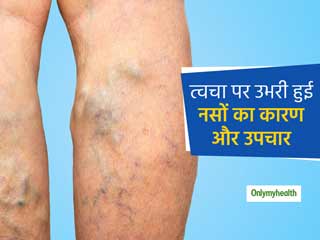 त्‍वचा पर ऊभरी और मुड़ी हुई नसें 'स्‍पाइडर वेन्‍स' के हैं लक्षण, जानें इसके कारण और घरेलू उपचार