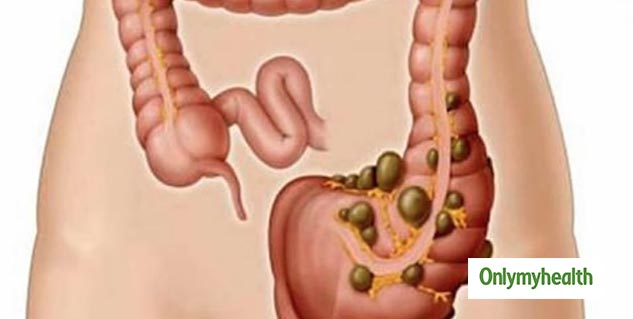 stomach-pain-and-blood-in-stool-may-be-early-sign-of-ulcerative-colitis