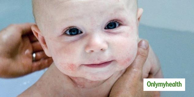 Know About The Treatment Of Baby Eczema In Hindi बच च म एक ज म ह न पर अपन ए य घर ल उपच र ज न क य ह एक ज म क लक षण और क रण