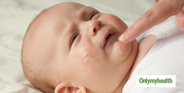 Know About The Treatment Of Baby Eczema In Hindi बच च म एक ज म ह न पर अपन ए य घर ल उपच र ज न क य ह एक ज म क लक षण और क रण