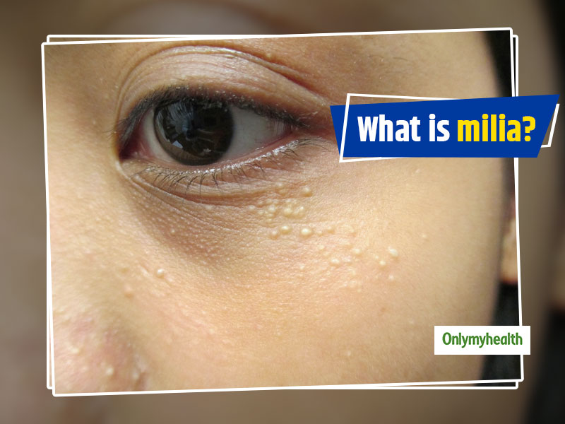 what-is-milia-ways-to-get-rid-of-these-white-spots-onlymyhealth