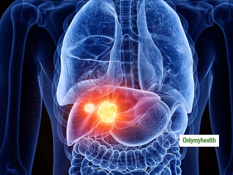 Liver Cancer Death Cases Increased By 50 Research