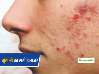 पिम्पल्स होने पर घरेलू नुस्खों के प्रयोग से हो सकता है नुकसान, जानें कील-मुंहासों के लिए 4 स्टैंडर्ड ट्रीटमेंट