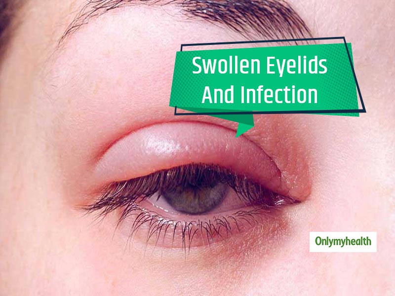 swollen-eye