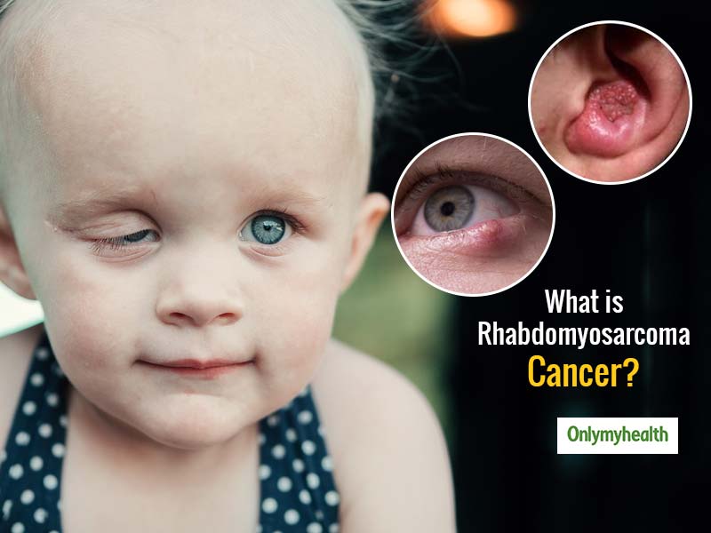 All About Rhabdomyosarcoma Cancer In Children | OnlyMyHealth