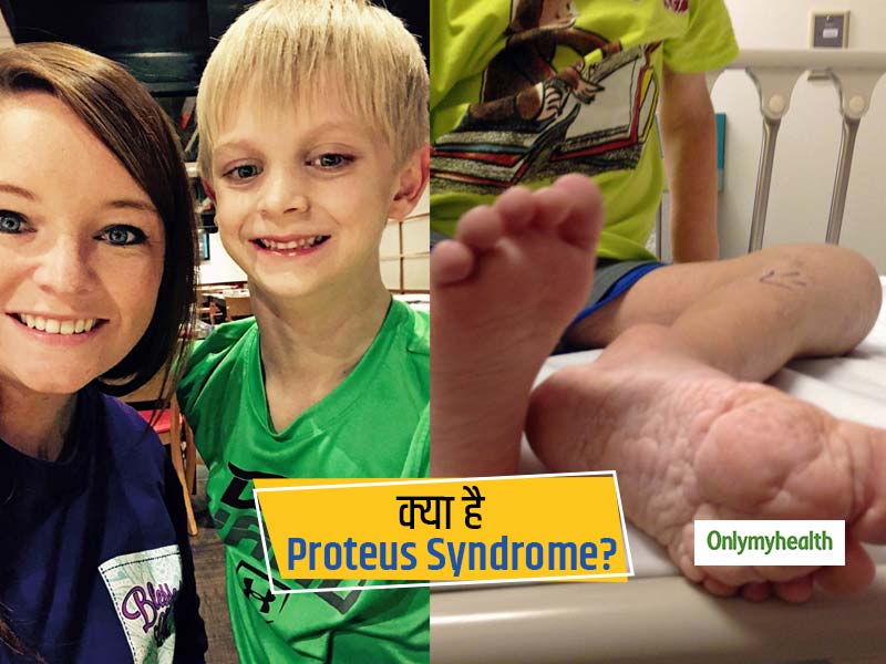 शरीर के कई अंगों का बढ़ना हो सकता है प्रोटीस सिंड्रोम (Proteus Syndrome) का संकेत, जानें कारण, लक्षण और उपाय
