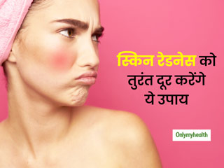 Remedies For Skin Redness: क्‍या आपकी भी है सेंसेटिव स्किन?  तो स्किन रेडनेस होने पर झट से करें ये 3 काम