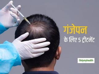 गंजेपन को छुपाने के लिए पुरुष कर रहें हैं इन 5 तरीकों का इस्तेमाल, दुनियाभर में पॉपुलर हो रहे हैं ये तरीके