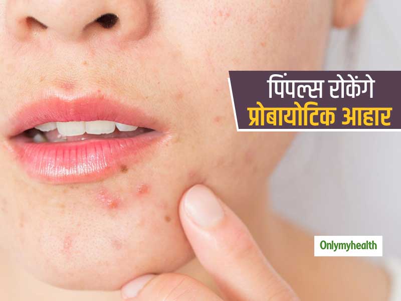 मुंहासे ज्यादा होते हैं तो खाइए दही, छाछ और योगर्ट, प्रोबायोटिक फूड्स हैं कील-मुंहासों को रोकने में कारगर