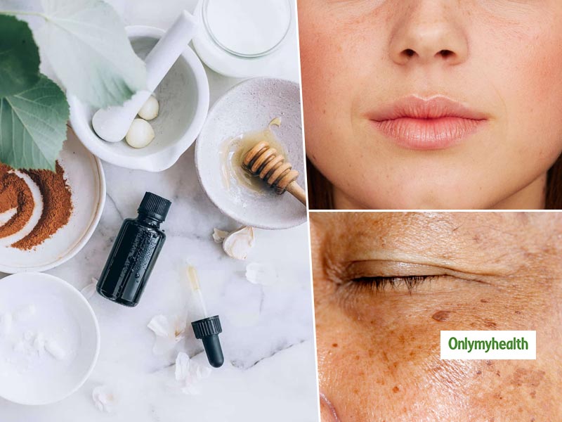 Hyperpigmentation Skin Treatment: How To Get Crystal Clear Skin Naturally At Home?