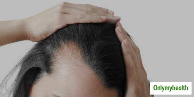 hairfall