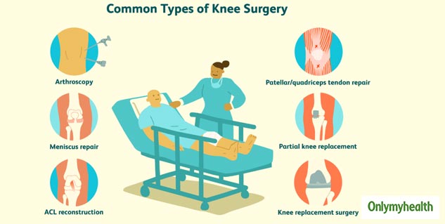 Myths and Facts on Total Knee Replacement Surgery ...