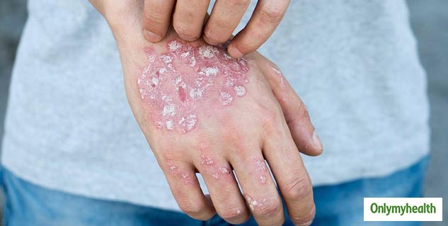 Experiencing Palm Rashes? Here's Are Some Treatment Tips