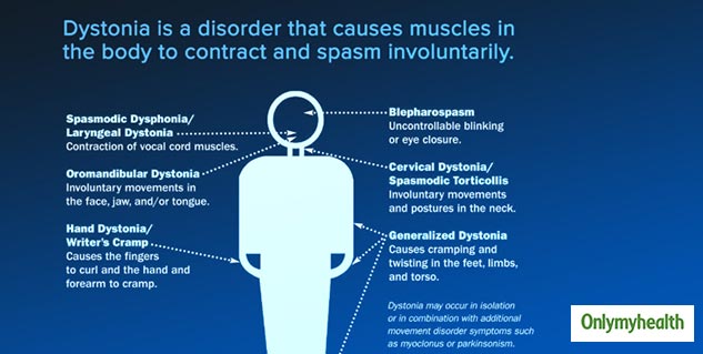 Involuntary Movements Can Be Dystonia. Know All About This Neurological ...